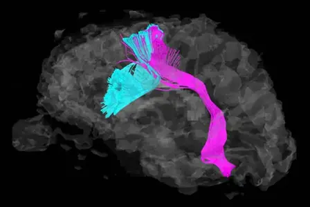 Asperger_vs_normal_brain_cr.webp