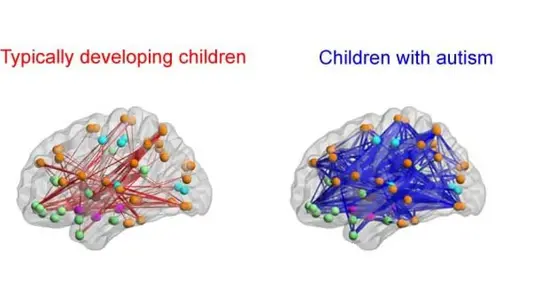 Normal Vs Autistic brain