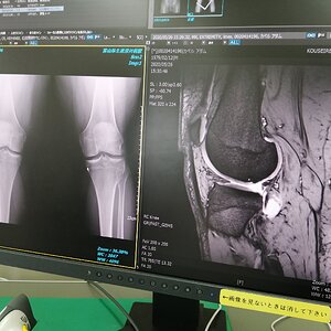 Knee MRI and x-rays