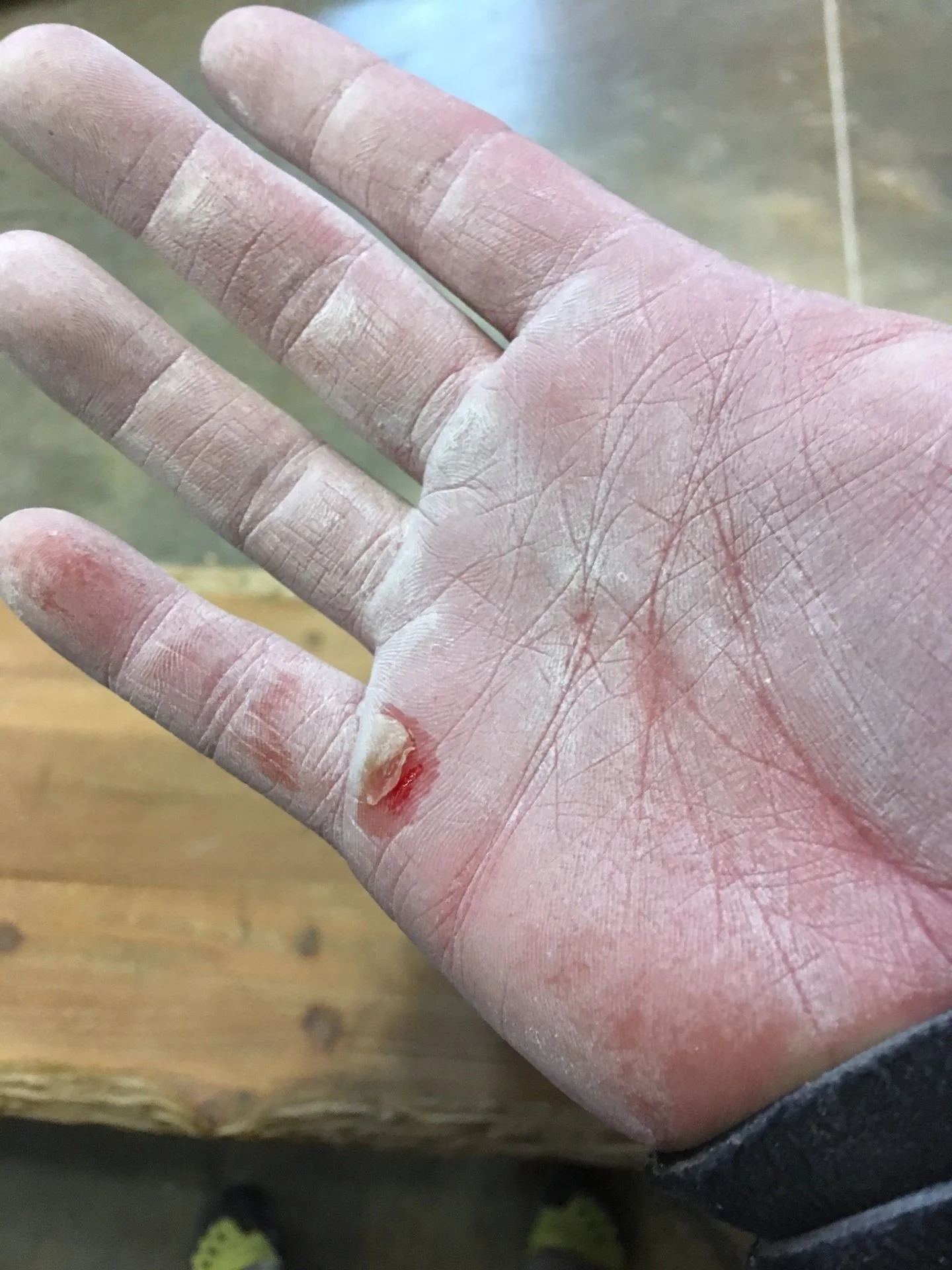 Torn skin 06/13/2018