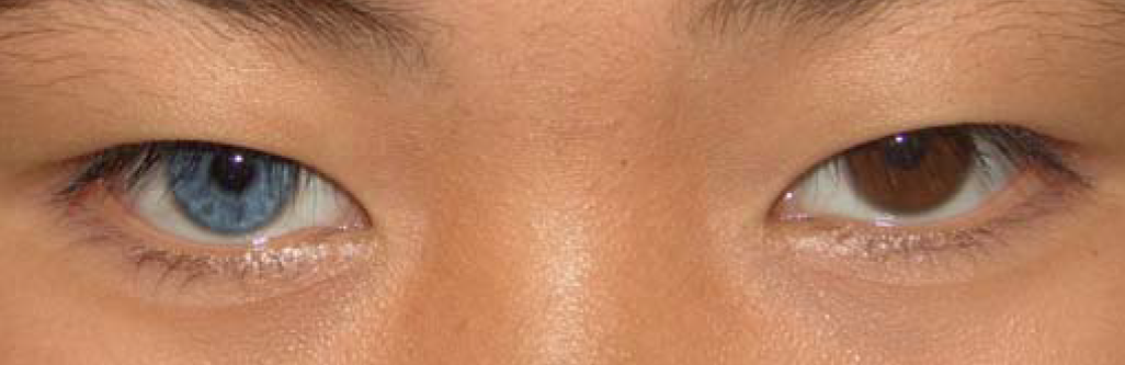 Heterochromia_plos.png