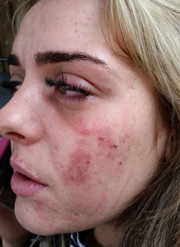 Chloe-Helson-injuries-657312.jpg