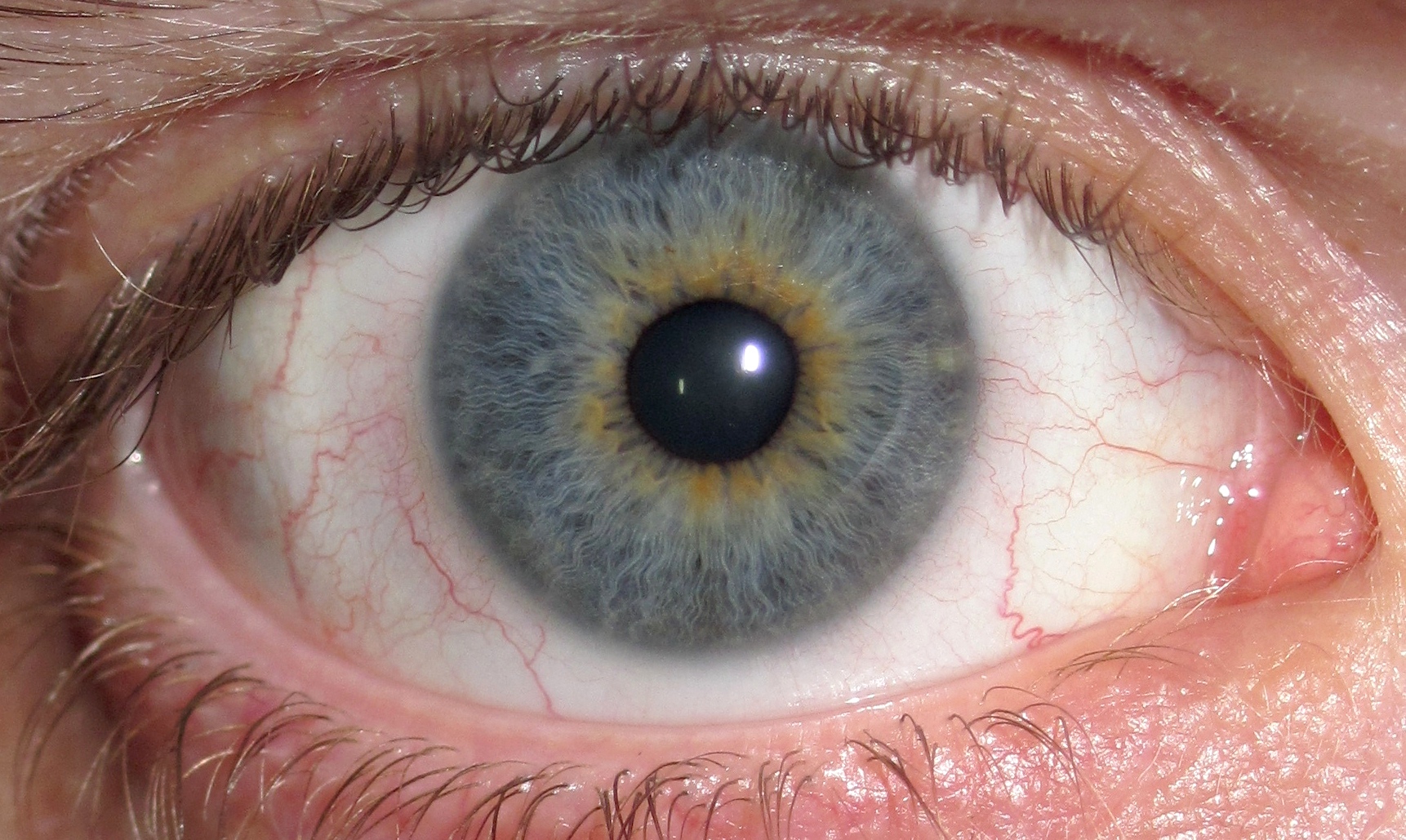 Eye_Central_Heterochromia_crop_and_lighter.jpg