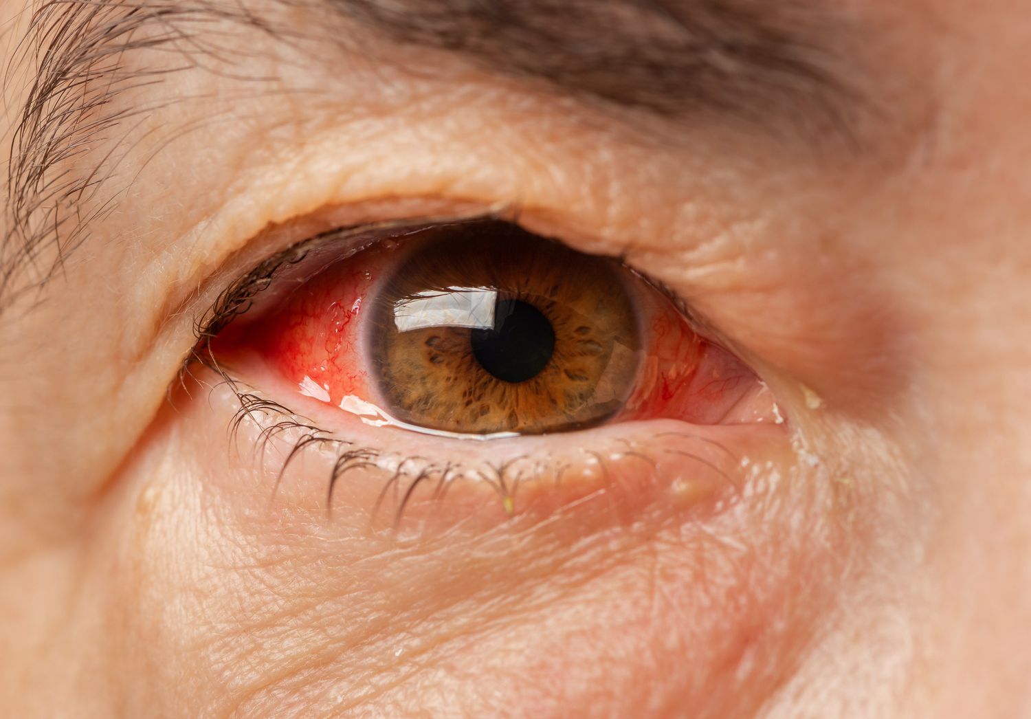 Red Eyes: Symptoms, Causes, and Treatments